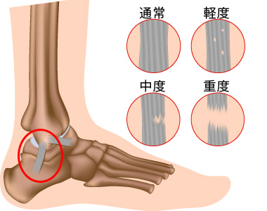 捻挫の種類